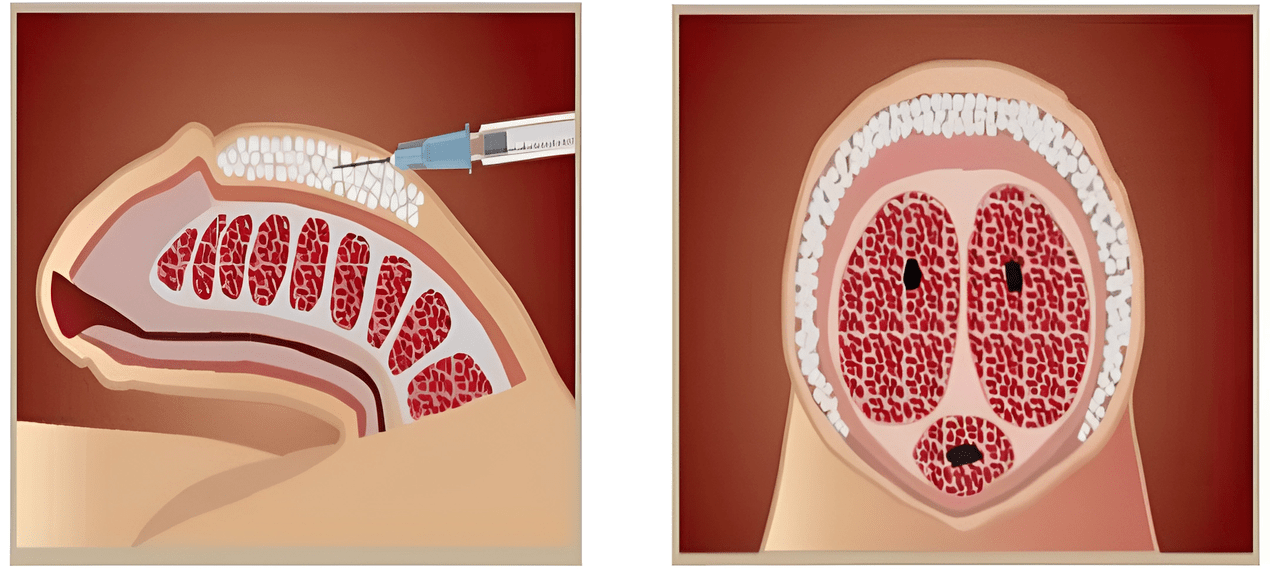 filler injection areas