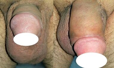 Photo before and after increasing the penis