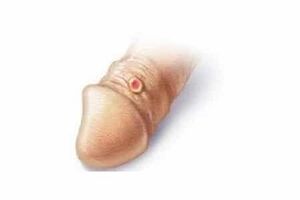 contraindications for penis enlargement with soda