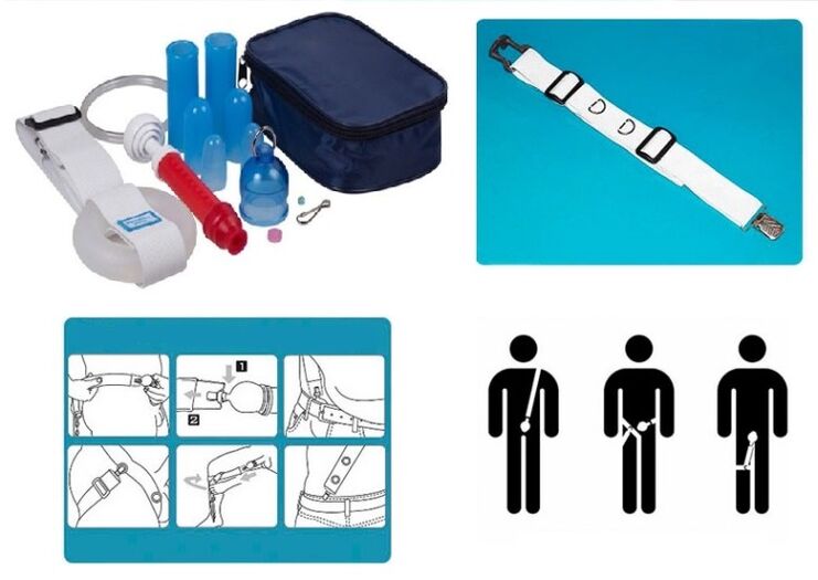 Lengthening and enlargement of the penis can be achieved with a stretcher