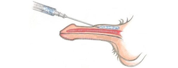 Lipofilling, which increases the size of the phallus